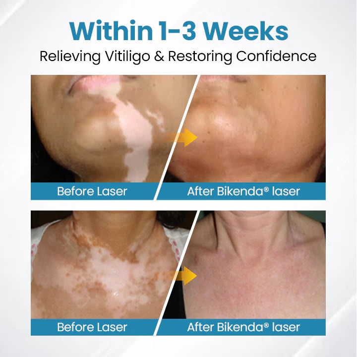 💥Biikenda® DermaBeam Vitiligo Therapy Device⏳Limited-time 49% off⏰💥