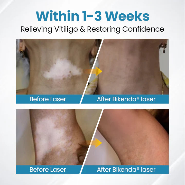 💥Biikenda® DermaBeam Vitiligo Therapy Device⏳Limited-time 49% off⏰💥