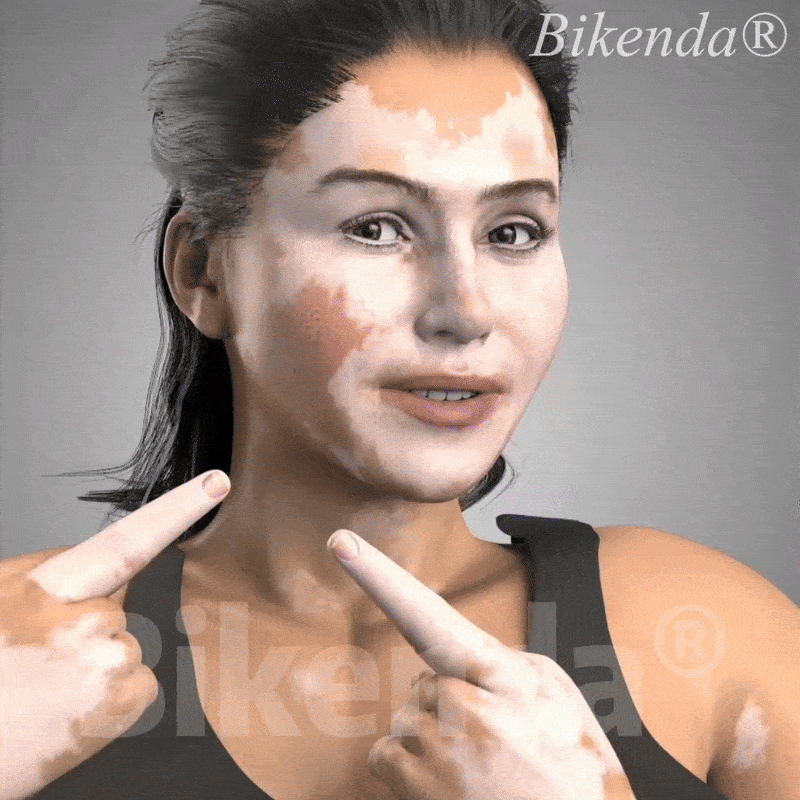 💥Biikenda® DermaBeam Vitiligo Therapy Device⏳Limited-time 49% off⏰💥