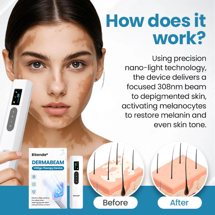 💥Biikenda® DermaBeam Vitiligo Therapy Device⏳Limited-time 49% off⏰💥