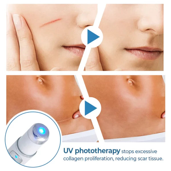 ScarFade™ UV Phototherapy Scar Removal Pen